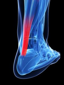 achilles tendonitis causes and treatment
