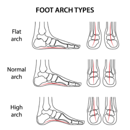 Flatfeet Ankle Pain Diagnosis and Treatment