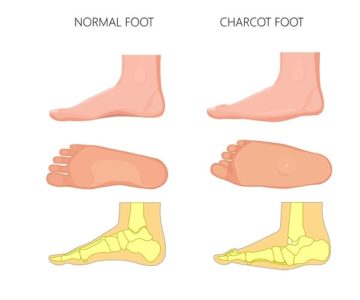 Charcot Foot is Caused when the Foot Bones Fracture