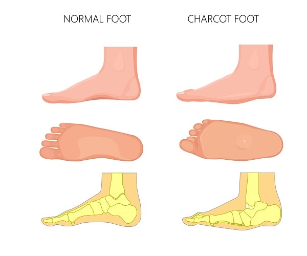 charcot foot treatment