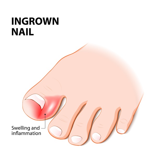 Get Rid of Painful Ingrown Toenails for Long Lasting Relief