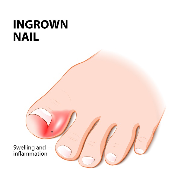 Management for Ingrown Toenail