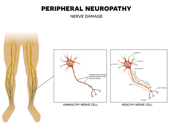 peripheral neuropathy and chronic pain