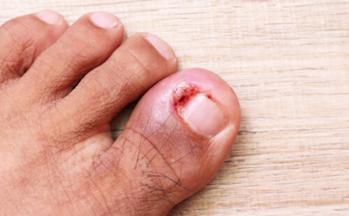 Ingrown Toenail Treatment is Your Answer to Pain Free Toenails
