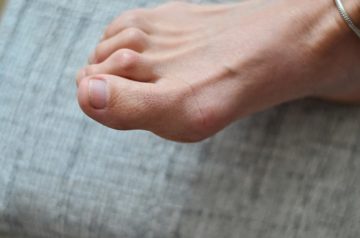 hammertoes women foot