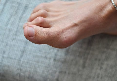 hammertoes women foot