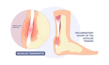 achilles tendonitis