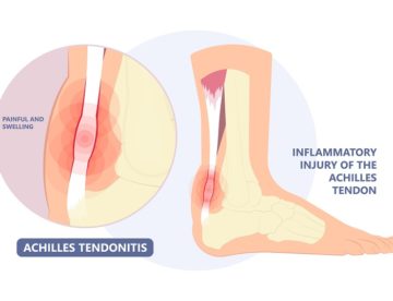 Arthritis Foot Care and Treatment Methods for You