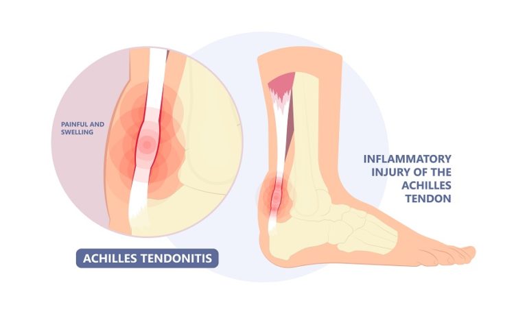 Bid Goodbye to Achilles Tendon Heel Pain, Get Back on Your Feet!