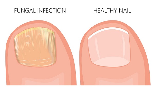 How to Tell if You Have a Toenail Fungus - Colorado Center of