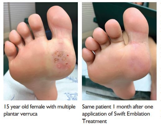 plantar wart removal stages