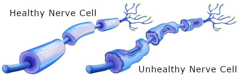 Nerve Cell Damaged vs Normal Comparison