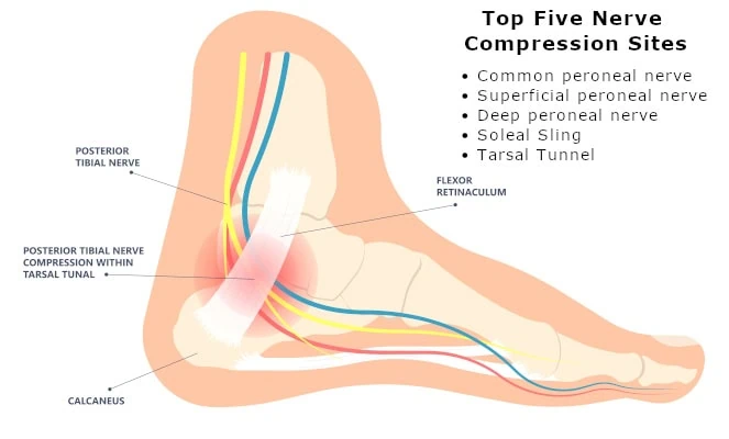 nerve compression inforgraphic andersonpodiatry to understand the stages peripheral neuropathy