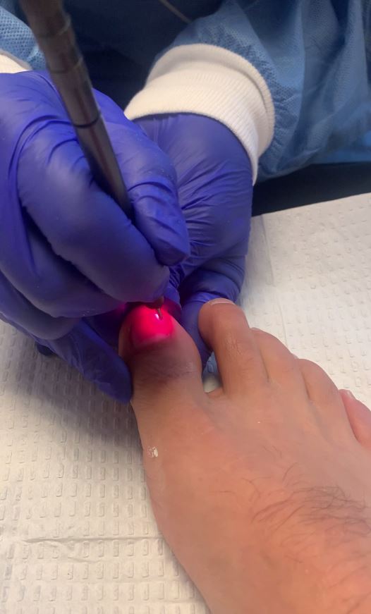 laser-nail-treatment-blog-anderson-podiatry-center