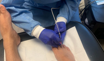 fungal nail treatment using the laser pinponte system
