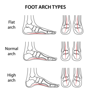 flat feet treatment