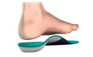 orthotic flatfeet ankle swelling