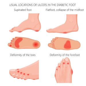 Diabetic Charcot Foot: Symptoms, Diagnosis and Treatments