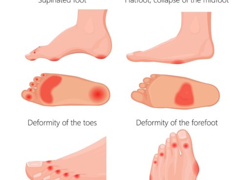 charcot-foot-diabetic-foot-anderson-podiatry