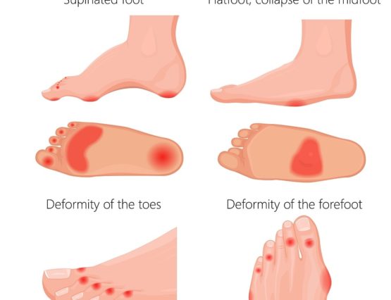 Flatfeet Ankle Pain Diagnosis and Treatment