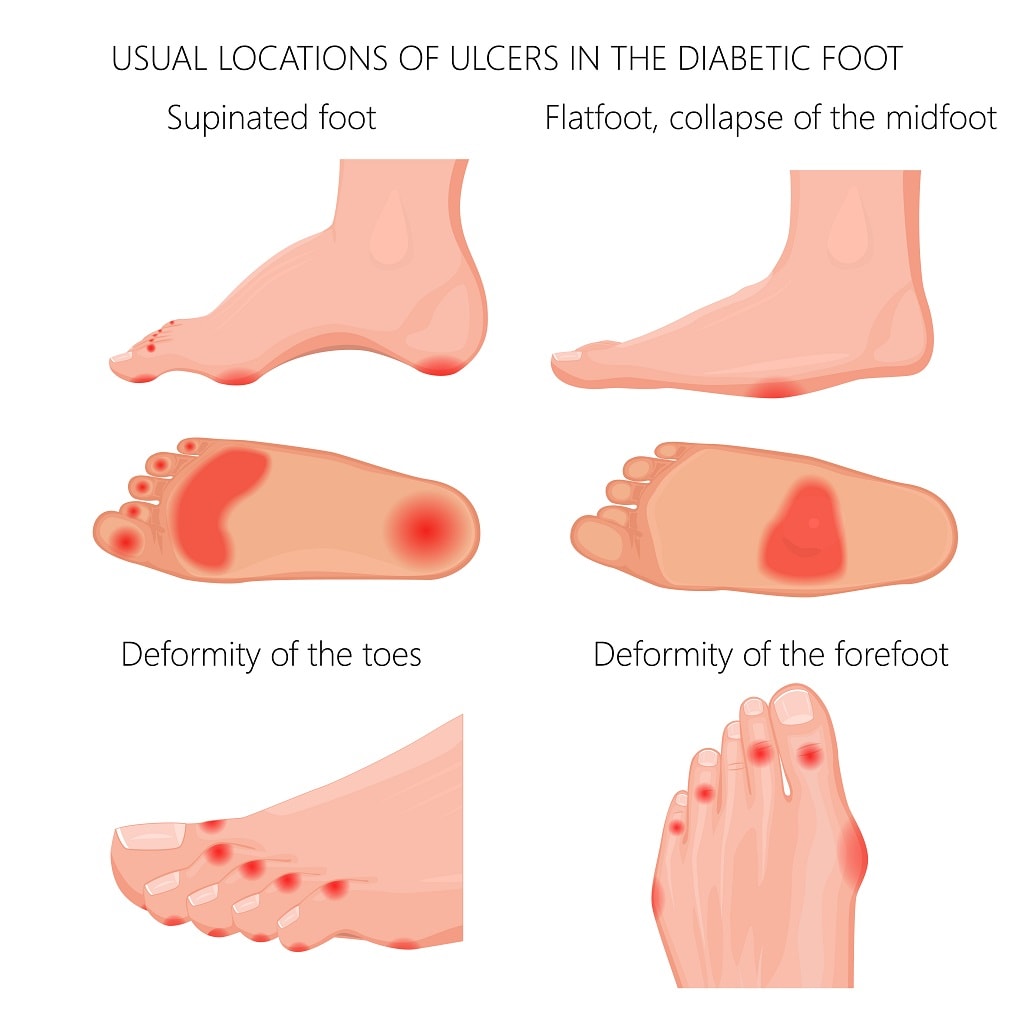 diabetic charcot deformity of the forefoot