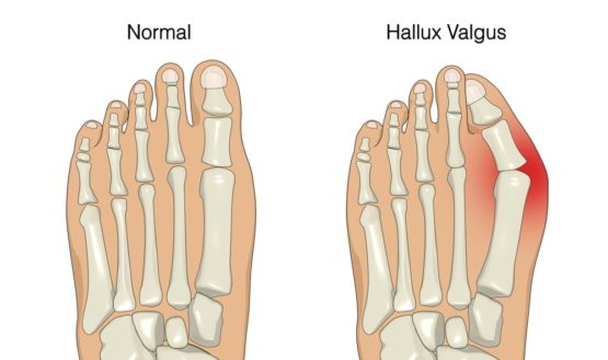 Things to do for bunion pain relief before seeing a podiatrist