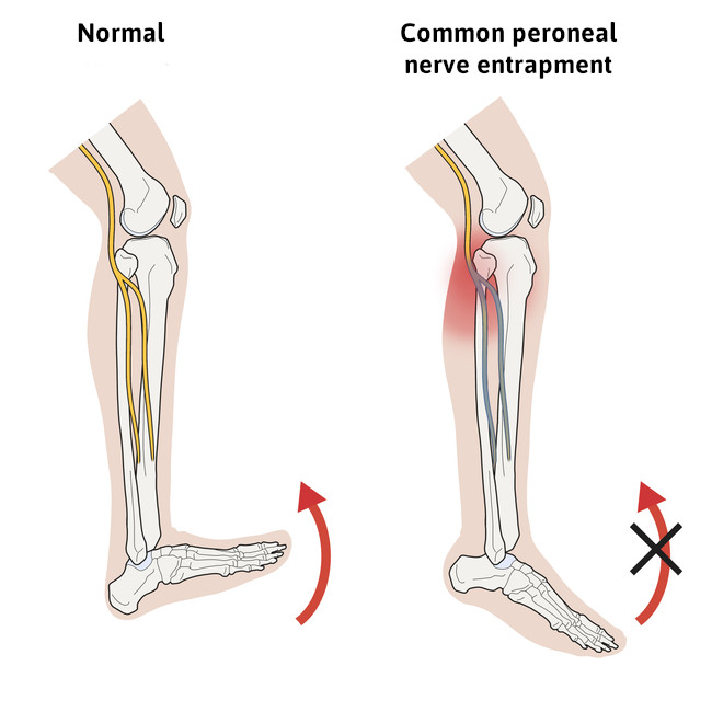 peroneal nerve foot drop