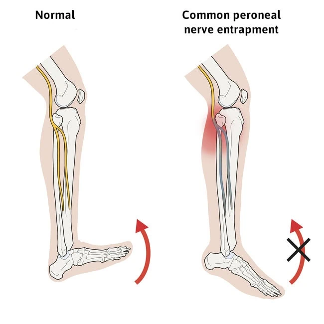 infographic drop foot common peroneal nerve entrapment