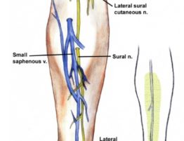 sural-nerve-pain
