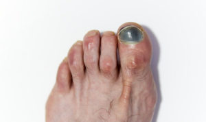 black toenail discoloration foot fungus