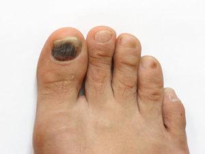 brown toenail discoloration foot fungus
