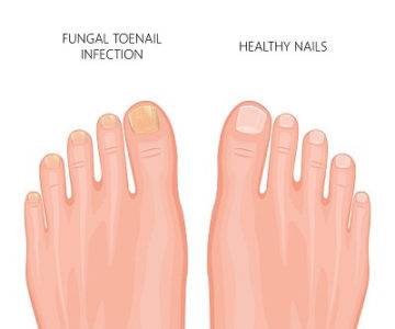 Toenail Discoloration making you unhappy? There is a way out!