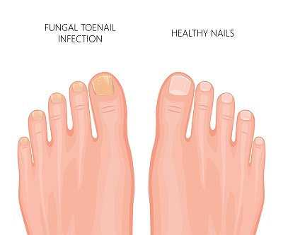 healthy versus fungal toe nail