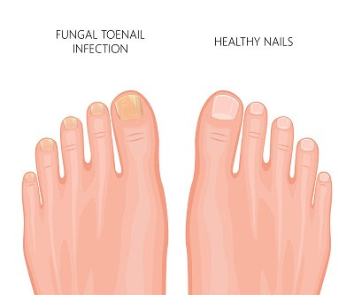 Nail diseases chart: Pictures, symptoms, and treatments