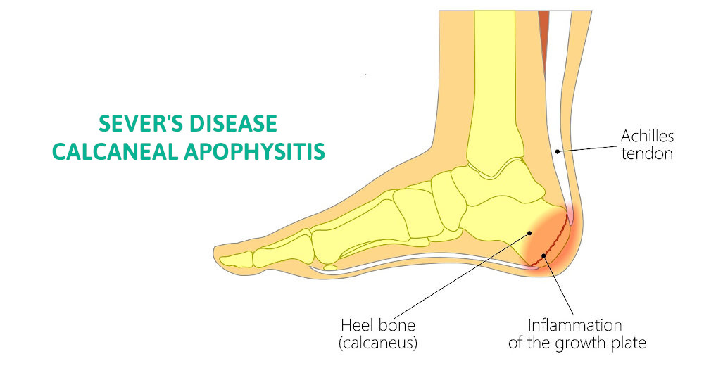 Bone enlargement in on sale heel