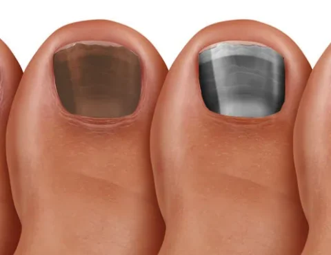 Toenail Discoloration, Its Causes and Treatment Options Anderson Podiatry Center