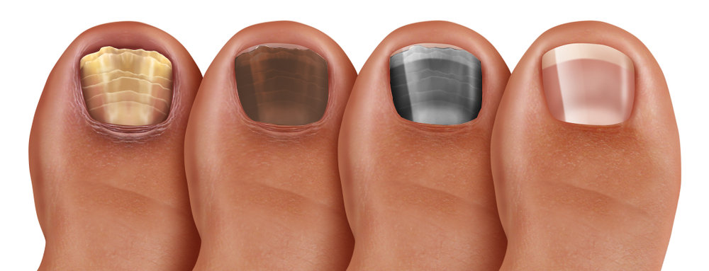 What causes black spots under my toenails? - Quora