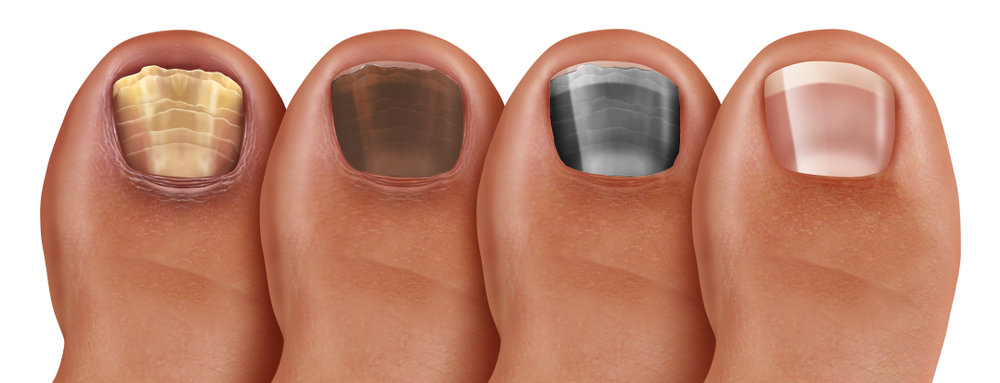 How to Tell if You Have a Toenail Fungus - Colorado Center of