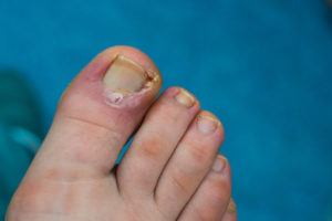 Patient toenail staph infection