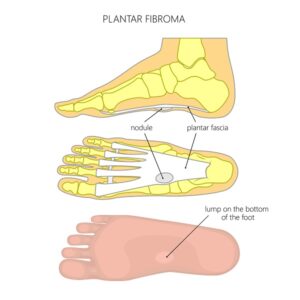 Plantar Fibroma Infographic