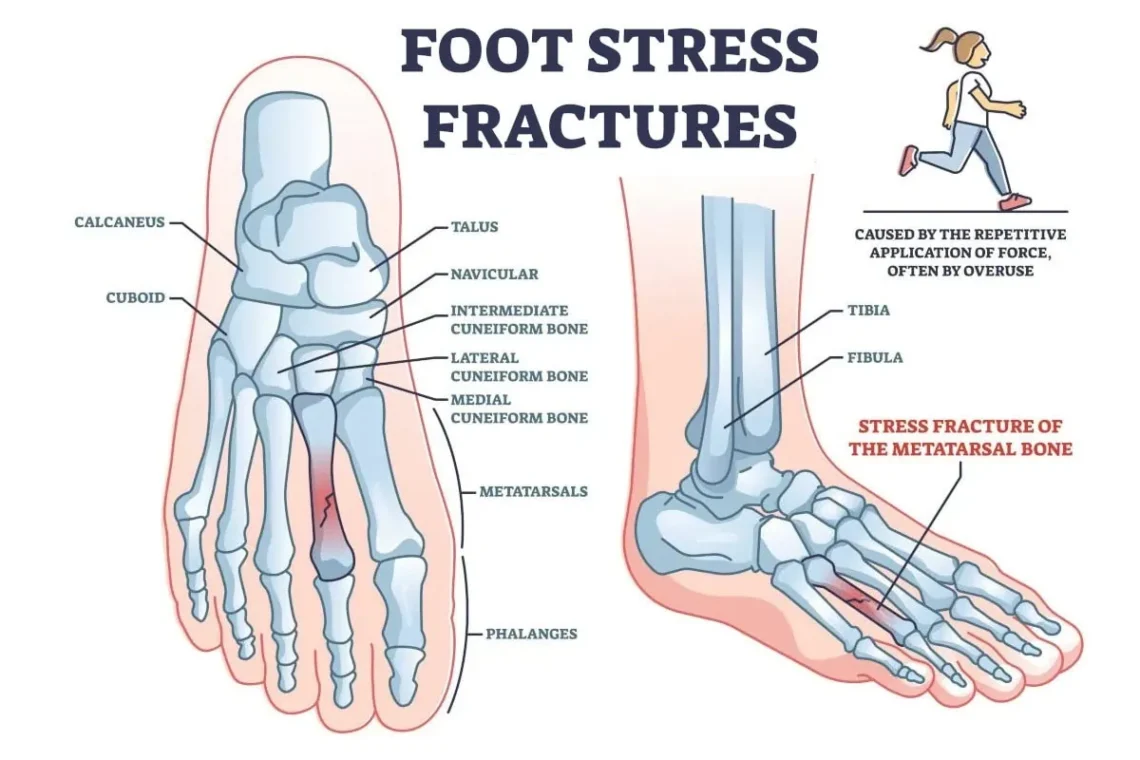 stress fracture in foot