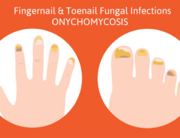 fingernail fungus laser treatment