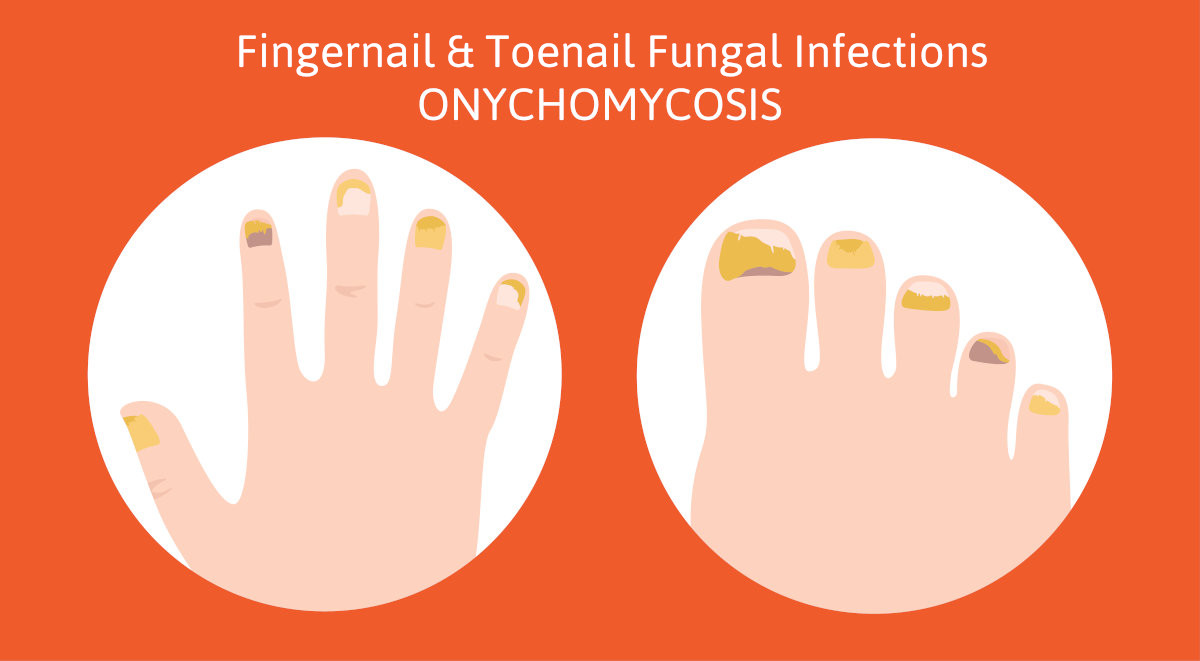 Does Home Laser Work on Toenail Fungus? — FOOT & ANKLE CENTERS