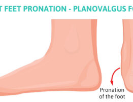 flat feet pronation