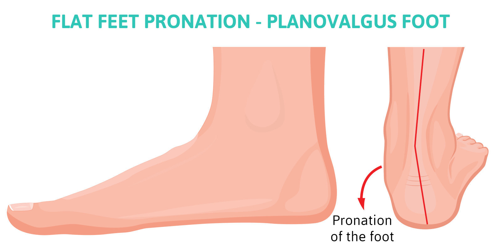 Flat Feet Pronation - Complications from Overpronation