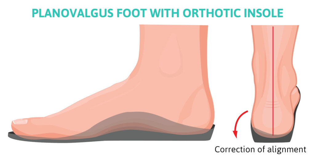 correction of flat feet pronation using orthotics