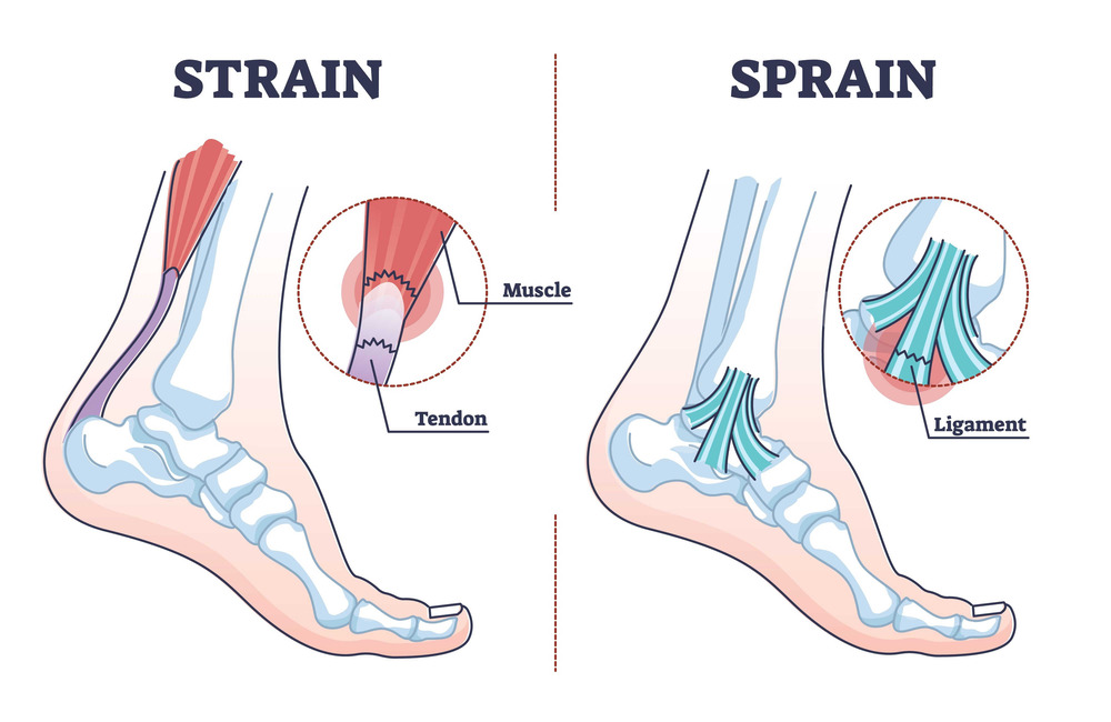 High ankle sprain: How to recognize and treat