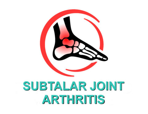subtalar joint arthritis