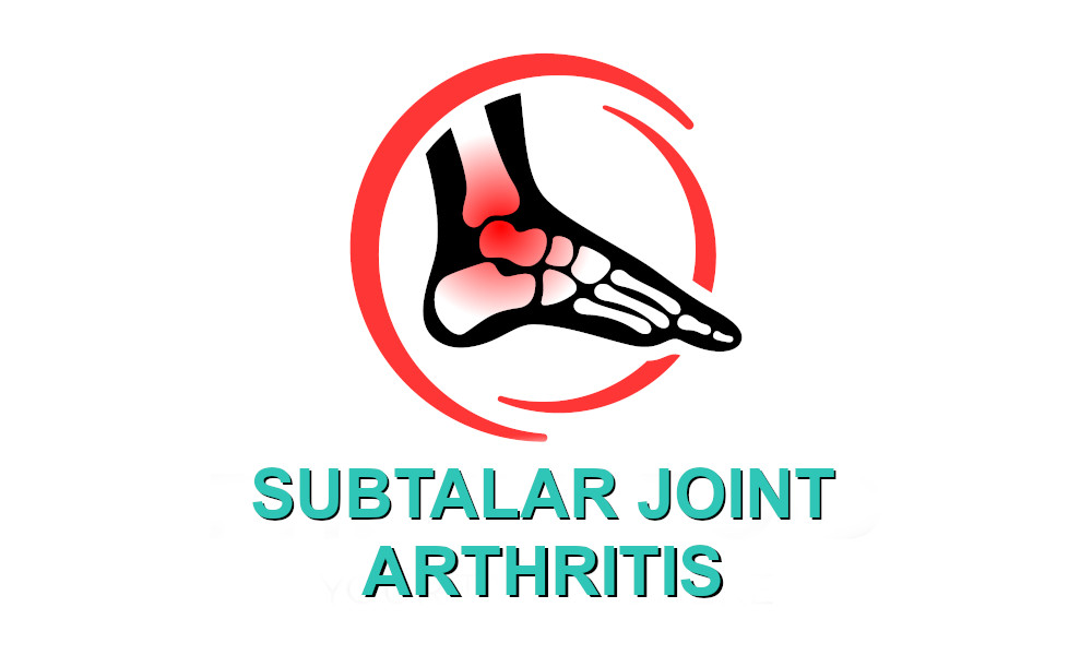 subtalar joint arthritis