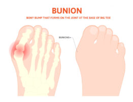foot-surgery-for-bunions